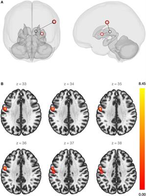 Effects of Estradiol Therapy on Resting-State Functional Connectivity of Transgender Women After Gender-Affirming Related Gonadectomy